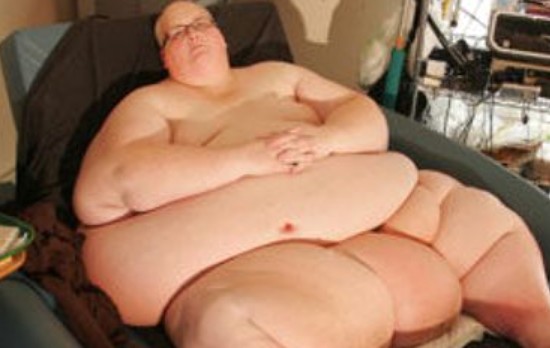 世界上最胖的人减掉500斤肉 手臂皮肤松成蝙蝠翅膀